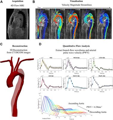 Calibration of patient-specific boundary conditions for coupled CFD models of the aorta derived from 4D Flow-MRI